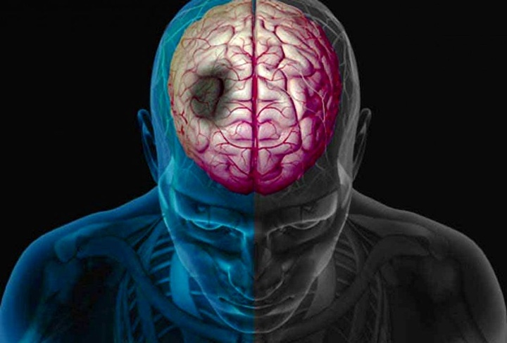 سن سکته مغزی پایین آمده است / سالانه ۱۲ هزار نفر مبتلا